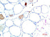 Immunohistochemical analysis of paraffin-embedded Human Liver Carcinoma Tissue using TTR Mouse mAb diluted at 1:200.