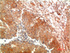 Immunohistochemical analysis of paraffin-embedded Human Breast Carcinoma Tissue using ATG5 Mouse mAb diluted at 1:2000