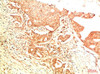 Immunohistochemical analysis of paraffin-embedded Human Breast Carcinoma Tissue using Acetyl P53 (K382) Mouse mAb diluted at 1:200.