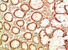 Immunohistochemical analysis of paraffin-embedded Human Colon Carcinoma Tissue using Acetyl P53 (K382) Mouse mAb diluted at 1:2000