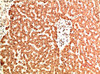 Immunohistochemical analysis of paraffin-embedded Human Liver Carcinoma Tissue using Collagen IV Mouse mAb diluted at 1:200.