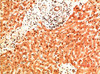 Immunohistochemical analysis of paraffin-embedded Human Liver Carcinoma Tissue using Collagen IV Mouse mAb diluted at 1:200.