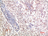 Immunohistochemical analysis of paraffin-embedded Human Lung Carcinoma Tissue using Collagen II Mouse mAb diluted at 1:500