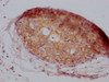 IHC image of CSB-MA907551 diluted at 1:100 and staining in paraffin-embedded human breast cancer performed on a Leica BondTM system. After dewaxing and hydration, antigen retrieval was mediated by high pressure in a citrate buffer (pH 6.0) . Section was blocked with 10% normal goat serum 30min at RT. Then primary antibody (1% BSA) was incubated at 4°C overnight. The primary is detected by a Goat anti-mouse IgG polymer labeled by HRP and visualized using 0.05% DAB.