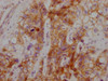 IHC image of CSB-MA907551 diluted at 1:100 and staining in paraffin-embedded human liver cancer performed on a Leica BondTM system. After dewaxing and hydration, antigen retrieval was mediated by high pressure in a citrate buffer (pH 6.0) . Section was blocked with 10% normal goat serum 30min at RT. Then primary antibody (1% BSA) was incubated at 4°C overnight. The primary is detected by a Goat anti-mouse IgG polymer labeled by HRP and visualized using 0.05% DAB.