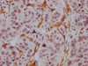IHC image of CSB-MA918107 diluted at 1:100 and staining in paraffin-embedded human liver cancer performed on a Leica BondTM system. After dewaxing and hydration, antigen retrieval was mediated by high pressure in a citrate buffer (pH 6.0) . Section was blocked with 10% normal goat serum 30min at RT. Then primary antibody (1% BSA) was incubated at 4°C overnight. The primary is detected by a Goat anti-mouse IgG polymer labeled by HRP and visualized using 0.05% DAB.