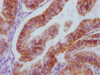 IHC image of CSB-MA963136 diluted at 1:100 and staining in paraffin-embedded human endometrial cancer performed on a Leica BondTM system. After dewaxing and hydration, antigen retrieval was mediated by high pressure in a citrate buffer (pH 6.0) . Section was blocked with 10% normal goat serum 30min at RT. Then primary antibody (1% BSA) was incubated at 4°C overnight. The primary is detected by a Goat anti-mouse IgG polymer labeled by HRP and visualized using 0.05% DAB.
