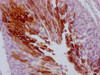 IHC image of CSB-MA299720 diluted at 1:100 and staining in paraffin-embedded human cervical cancer performed on a Leica BondTM system. After dewaxing and hydration, antigen retrieval was mediated by high pressure in a citrate buffer (pH 6.0) . Section was blocked with 10% normal goat serum 30min at RT. Then primary antibody (1% BSA) was incubated at 4°C overnight. The primary is detected by a Goat anti-mouse IgG polymer labeled by HRP and visualized using 0.05% DAB.