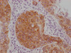 IHC image of CSB-MA589883 diluted at 1:100 and staining in paraffin-embedded human cervical cancer performed on a Leica BondTM system. After dewaxing and hydration, antigen retrieval was mediated by high pressure in a citrate buffer (pH 6.0) . Section was blocked with 10% normal goat serum 30min at RT. Then primary antibody (1% BSA) was incubated at 4°C overnight. The primary is detected by a Goat anti-mouse IgG polymer labeled by HRP and visualized using 0.05% DAB.
