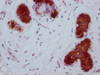 IHC image of CSB-MA785224 diluted at 1:100 and staining in paraffin-embedded human breast cancer performed on a Leica BondTM system. After dewaxing and hydration, antigen retrieval was mediated by high pressure in a citrate buffer (pH 6.0) . Section was blocked with 10% normal goat serum 30min at RT. Then primary antibody (1% BSA) was incubated at 4°C overnight. The primary is detected by a Goat anti-mouse IgG polymer labeled by HRP and visualized using 0.05% DAB.