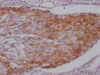 IHC image of CSB-MA785224 diluted at 1:100 and staining in paraffin-embedded human cervical cancer performed on a Leica BondTM system. After dewaxing and hydration, antigen retrieval was mediated by high pressure in a citrate buffer (pH 6.0) . Section was blocked with 10% normal goat serum 30min at RT. Then primary antibody (1% BSA) was incubated at 4°C overnight. The primary is detected by a Goat anti-mouse IgG polymer labeled by HRP and visualized using 0.05% DAB.