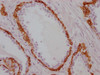 IHC image of CSB-MA986157 diluted at 1:100 and staining in paraffin-embedded human prostate cancer performed on a Leica BondTM system. After dewaxing and hydration, antigen retrieval was mediated by high pressure in a citrate buffer (pH 6.0) . Section was blocked with 10% normal goat serum 30min at RT. Then primary antibody (1% BSA) was incubated at 4°C overnight. The primary is detected by a Goat anti-mouse IgG polymer labeled by HRP and visualized using 0.05% DAB.