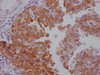 IHC image of CSB-MA986157 diluted at 1:100 and staining in paraffin-embedded human cervical cancer performed on a Leica BondTM system. After dewaxing and hydration, antigen retrieval was mediated by high pressure in a citrate buffer (pH 6.0) . Section was blocked with 10% normal goat serum 30min at RT. Then primary antibody (1% BSA) was incubated at 4°C overnight. The primary is detected by a Goat anti-mouse IgG polymer labeled by HRP and visualized using 0.05% DAB.
