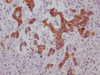 IHC image of CSB-MA974483 diluted at 1:100 and staining in paraffin-embedded human gastric cancer performed on a Leica BondTM system. After dewaxing and hydration, antigen retrieval was mediated by high pressure in a citrate buffer (pH 6.0) . Section was blocked with 10% normal goat serum 30min at RT. Then primary antibody (1% BSA) was incubated at 4°C overnight. The primary is detected by a Goat anti-mouse IgG polymer labeled by HRP and visualized using 0.05% DAB.