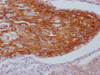 IHC image of CSB-MA550667 diluted at 1:100 and staining in paraffin-embedded human cervical cancer performed on a Leica BondTM system. After dewaxing and hydration, antigen retrieval was mediated by high pressure in a citrate buffer (pH 6.0) . Section was blocked with 10% normal goat serum 30min at RT. Then primary antibody (1% BSA) was incubated at 4°C overnight. The primary is detected by a Goat anti-mouse IgG polymer labeled by HRP and visualized using 0.05% DAB.
