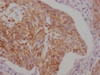 IHC image of CSB-MA898464 diluted at 1:100 and staining in paraffin-embedded human cervical cancer performed on a Leica BondTM system. After dewaxing and hydration, antigen retrieval was mediated by high pressure in a citrate buffer (pH 6.0) . Section was blocked with 10% normal goat serum 30min at RT. Then primary antibody (1% BSA) was incubated at 4°C overnight. The primary is detected by a Goat anti-mouse IgG polymer labeled by HRP and visualized using 0.05% DAB.