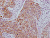 IHC image of CSB-MA949708 diluted at 1:100 and staining in paraffin-embedded human cervical cancer performed on a Leica BondTM system. After dewaxing and hydration, antigen retrieval was mediated by high pressure in a citrate buffer (pH 6.0) . Section was blocked with 10% normal goat serum 30min at RT. Then primary antibody (1% BSA) was incubated at 4°C overnight. The primary is detected by a Goat anti-mouse IgG polymer labeled by HRP and visualized using 0.05% DAB.