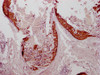 IHC image of CSB-MA634481 diluted at 1:100 and staining in paraffin-embedded human breast cancer performed on a Leica BondTM system. After dewaxing and hydration, antigen retrieval was mediated by high pressure in a citrate buffer (pH 6.0) . Section was blocked with 10% normal goat serum 30min at RT. Then primary antibody (1% BSA) was incubated at 4°C overnight. The primary is detected by a Goat anti-mouse IgG polymer labeled by HRP and visualized using 0.05% DAB.