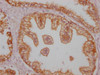 IHC image of CSB-MA999890 diluted at 1:100 and staining in paraffin-embedded human prostate cancer performed on a Leica BondTM system. After dewaxing and hydration, antigen retrieval was mediated by high pressure in a citrate buffer (pH 6.0) . Section was blocked with 10% normal goat serum 30min at RT. Then primary antibody (1% BSA) was incubated at 4°C overnight. The primary is detected by a Goat anti-mouse IgG polymer labeled by HRP and visualized using 0.05% DAB.