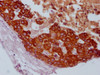 IHC image of CSB-MA789445 diluted at 1:100 and staining in paraffin-embedded human breast cancer performed on a Leica BondTM system. After dewaxing and hydration, antigen retrieval was mediated by high pressure in a citrate buffer (pH 6.0) . Section was blocked with 10% normal goat serum 30min at RT. Then primary antibody (1% BSA) was incubated at 4°C overnight. The primary is detected by a Goat anti-mouse IgG polymer labeled by HRP and visualized using 0.05% DAB.