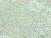 Immunohistochemical of paraffin-embedded human breast cancer using CSB-MA0187241A0m at dilution of 1:200