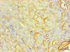 Immunohistochemical of paraffin-embedded human cervical cancer using CSB-MA0206411A0m at dilution of 1:200