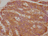Immunohistochemical of paraffin-embedded human colon cancer using CSB-MA0234331A0m at dilution of 1:50