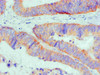 Immunohistochemical of paraffin-embedded Human Colon cancer tissue using CSB-MA0026131A0m at dilution of 1:200