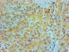 Immunohistochemical of paraffin-embedded Human live cancer tissue using CSB-MA8378691A0m at dilution of 1:200.