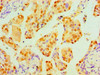 Immunohistochemical of paraffin-embedded Human lung cancer tissue using CSB-MA0240771A0m at dilution of 1:200.