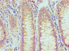 Immunohistochemical of paraffin-embedded Human rectum cancer tissue using CSB-MA0240771A0m at dilution of 1:200.