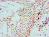 Immunohistochemical of paraffin-embedded Human breast cancer tissue using CSB-MA0240771A0m at dilution of 1:200.