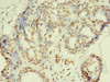 Immunohistochemistry of paraffin-embedded human breast cancer using CSB-MA0205181A0m in 30ug/ml dilute concentrations.