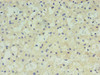 Immunohistochemistry of paraffin-embedded human liver cancer using CSB-MA027711E0m in 30ug/ml dilute concentrations.