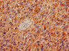 Immunohistochemistry of paraffin-embedded human glioma using CSB-MA009369A0m at dilution of 1:100