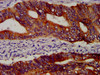 IHC image of CSB-MA018403A0m diluted at 1:100 and staining in paraffin-embedded human colon cancer performed on a Leica BondTM system. After dewaxing and hydration, antigen retrieval was mediated by high pressure in a citrate buffer (pH 6.0) . Section was blocked with 10% normal goat serum 30min at RT. Then primary antibody (1% BSA) was incubated at 4°C overnight. The primary is detected by a biotinylated secondary antibody and visualized using an HRP conjugated SP system.