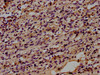 IHC image of CSB-MA004879A0m diluted at 1:100 and staining in paraffin-embedded human lung cancer performed on a Leica BondTM system. After dewaxing and hydration, antigen retrieval was mediated by high pressure in a citrate buffer (pH 6.0) . Section was blocked with 10% normal goat serum 30min at RT. Then primary antibody (1% BSA) was incubated at 4°C overnight. The primary is detected by a biotinylated secondary antibody and visualized using an HRP conjugated SP system.