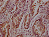 IHC image of CSB-MA026293A0m diluted at 1:200 and staining in paraffin-embedded human lung cancer tissue performed on a Leica BondTM system. After dewaxing and hydration, antigen retrieval was mediated by high pressure in a citrate buffer (pH 6.0) . Section was blocked with 10% normal goat serum 30min at 37℃. Then primary antibody (1% BSA) was incubated at 4°C overnight. The primary is detected by a Goat anti-rabbit IgG labeled by HRP and visualized using 0.05% DAB.