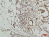 Immunohistochemical analysis of paraffin-embedded human Breast caricnoma using ERK 5 Polyclonal Antibody.