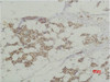 Immunohistochemical analysis of paraffin-embedded human Breast caricnoma using Histone H3 Polyclonal Antibody.