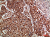 Immunohistochemical analysis of paraffin-embedded human-lung-cancer, antibody was diluted at 1:200