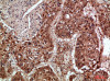 Immunohistochemical analysis of paraffin-embedded human-lung-cancer, antibody was diluted at 1:200