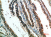 Immunohistochemical analysis of paraffin-embedded human-colon-cancer, antibody was diluted at 1:200