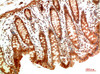 Immunohistochemical analysis of paraffin-embedded Human Colon Carcinoma Tissue using MEK2 Rabbit pAb diluted at 1:200