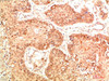 Immunohistochemical analysis of paraffin-embedded Human Lung Carcinoma Tissue using Nrf2 Rabbit pAb diluted at 1:500