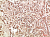 Immunohistochemical analysis of paraffin-embedded Human Breast Carcinoma Tissue using FAK Rabbit pAb diluted at 1:500