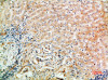 Immunohistochemical analysis of paraffin-embedded human-liver-cancer, antibody was diluted at 1:200