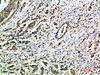 Immunohistochemical analysis of paraffin-embedded human-breast-cancer, antibody was diluted at 1:200