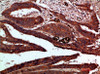 Immunohistochemical analysis of paraffin-embedded human-colon-cancer, antibody was diluted at 1:200