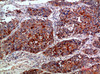 Immunohistochemical analysis of paraffin-embedded human-lung-cancer, antibody was diluted at 1:200